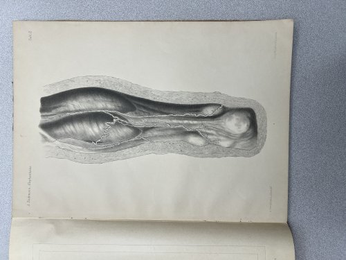 Die Lymphgefasse Bei Elephantiasis Arabum