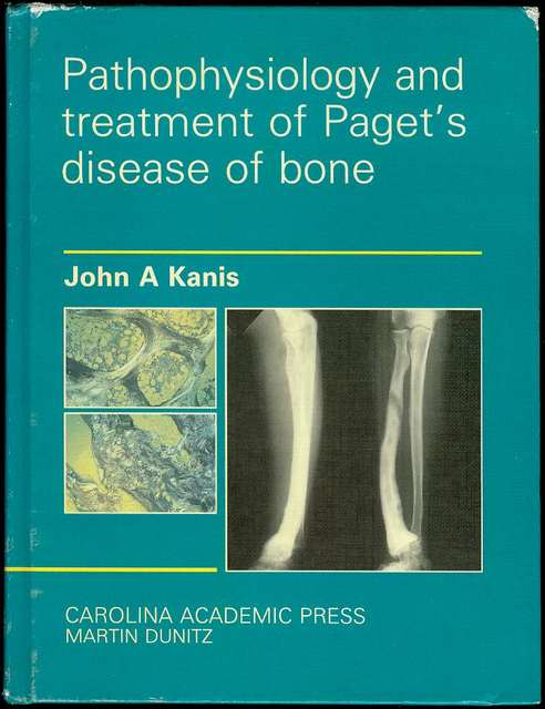 Pathophysiology and Treatment of Paget's Disease of Bone