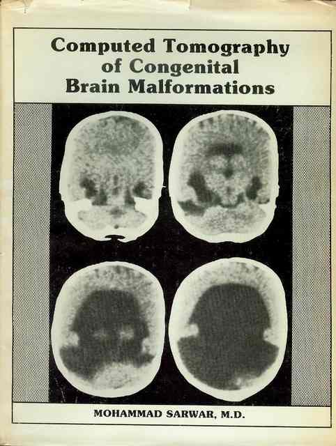Computed Tomography of Congenital Brain Malformations
