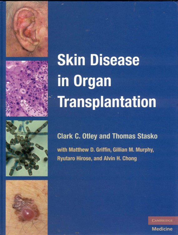 Skin Disease in Organ Transplantation