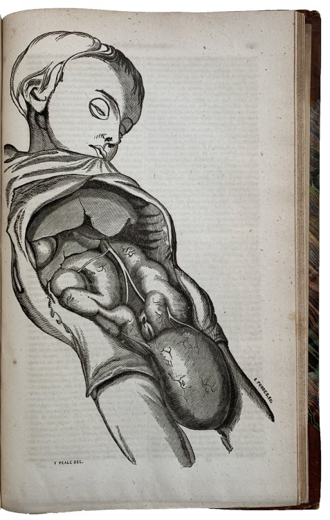 Congenital enlargement of the ureters. Fatal case of lithotomy, with examination post mortem.
