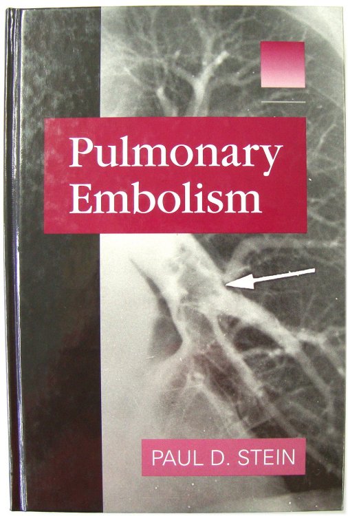 Pulmonary Embolism