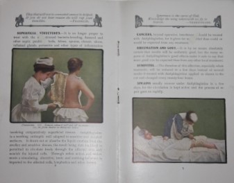 Antiphlogistine. Depletes Inflamed Areas. An External Application for Inflammation and Congestion