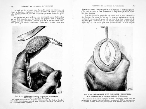 1) La greffe testiculaire. Technique operatoire, evolution histologique, manifestations physiologiques, published in Technique Chirurgicale, No 4, June 1967; 2) Testicular grafting from ape to man. Operative technique, histological evolution, physiological manifestations.
