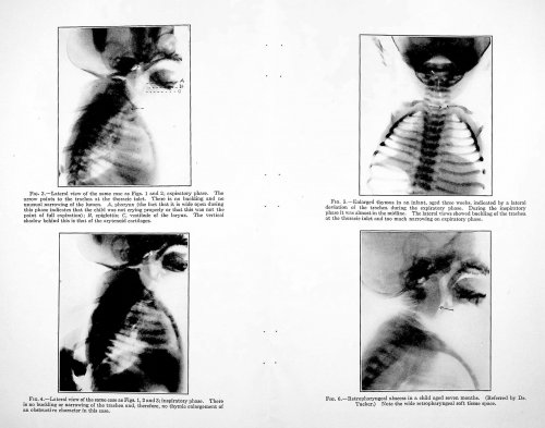 Roentgenology of the thymus in infancy and differential diagnoses of enlarged thymus and its treatment