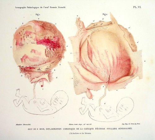Iconographie Pathologique de l'Oeuf Humain Feconde en rapport avec l'Etiologie de l'Avortement [Pathological Iconography of the Fertilized Human Egg in Relation to the Etiology of Abortion]