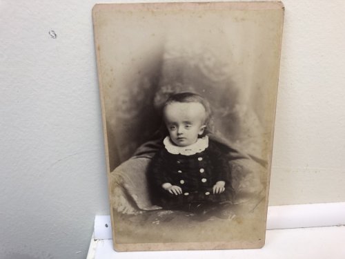 Hydrocephalus : Cabinet Card Photograph